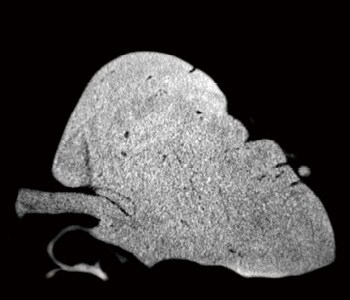 48歳女性の骨腫(osteoma)の撮像例